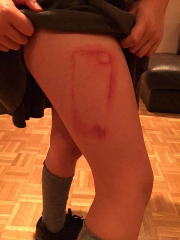 PIC FROM MERCURY PRESS (PICTURED: Olivia Retter's leg after her phone case leaked) A nine-year-old girl has been left scarred FOR LIFE by her phone case. Toxic pink glitter from Olivia Retterís phone case leaked onto her leg while she was in bed, leaving her with an angry chemical burn in the exact shape of her iPhone 5c. The youngster, from Ware, Hertfordshire, bought the phone case from New Look in December. Now shocked mum Karly Retterís post warning other parents to be aware of the danger posed by similar phone cases has gone viral, racking up nearly 13,000 Facebook shares. SEE MERCURY COPY
